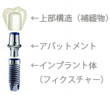 浜松市 インプラント 歯科 歯医者インプラントの構造