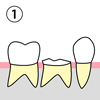 （１）残せなくなった歯があります。ここにインプラント治療を行います。