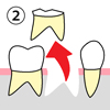 （２）残せなくなった歯を抜きます。