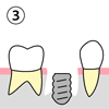 （３）抜歯してすぐにインプラントを埋入します。