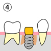 （４）骨とインプラントの隙間に骨補填材を詰めます。