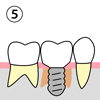 （５）状態によっては、すぐに仮歯を入れることができます。