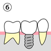 （６）一定期間に達するとインプラントのまわりは新しい骨で囲まれます。