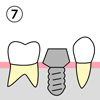 （７）仮歯をはずして、アバットメント（土台）を取り付けます。