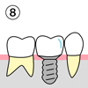 （８）型取りをして、最終的なかぶせ物を入れて治療終了です。